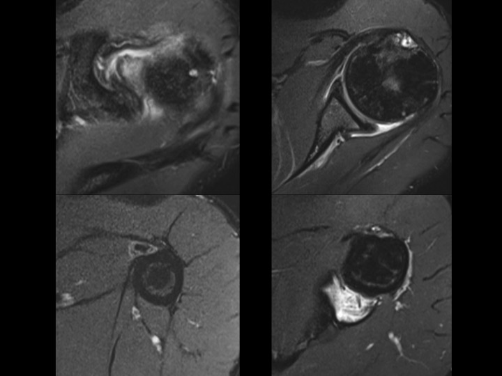 Figure 5 for case tendon of long head of biceps brachii ( RID1944 )